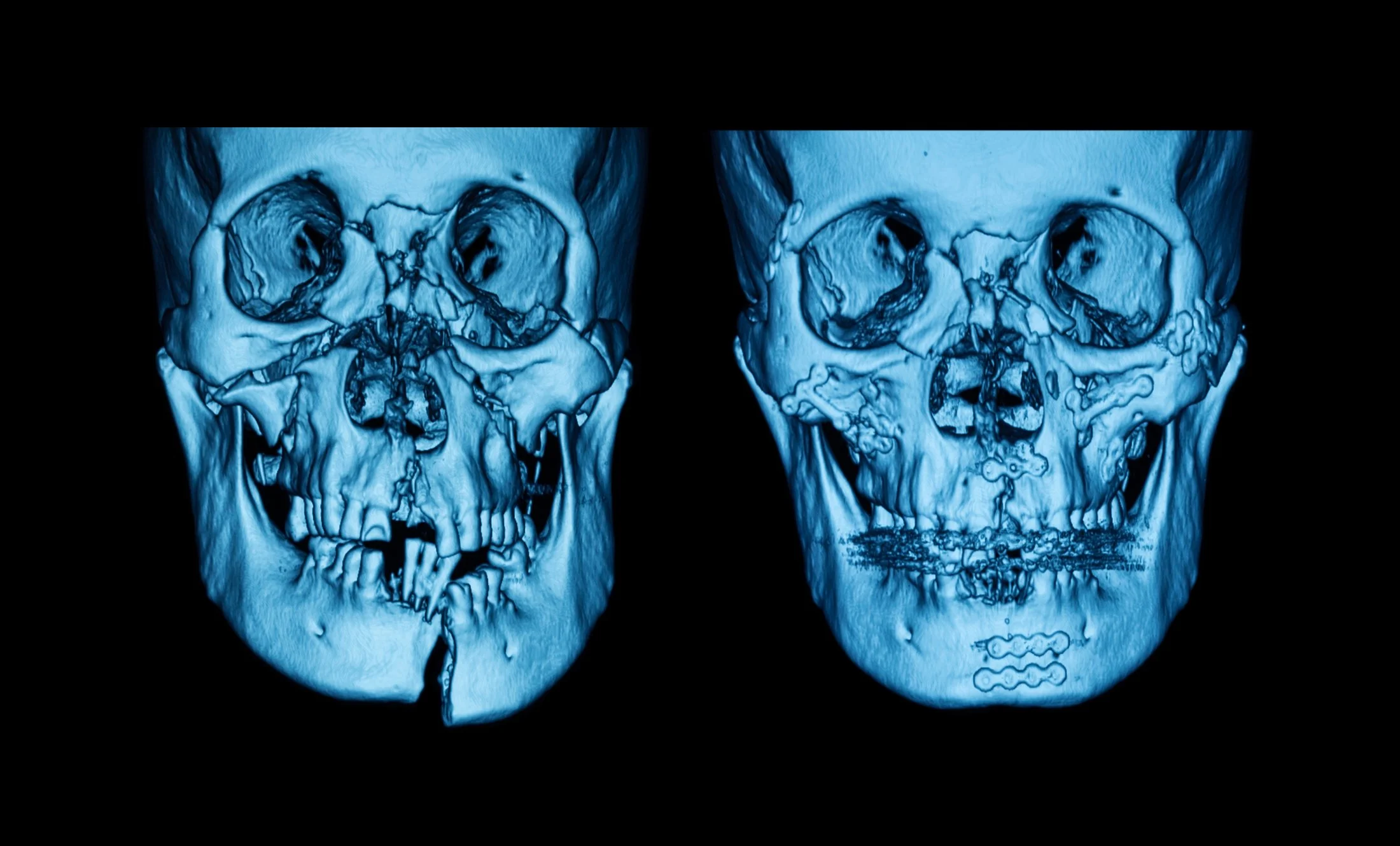Maxillofacial trauma